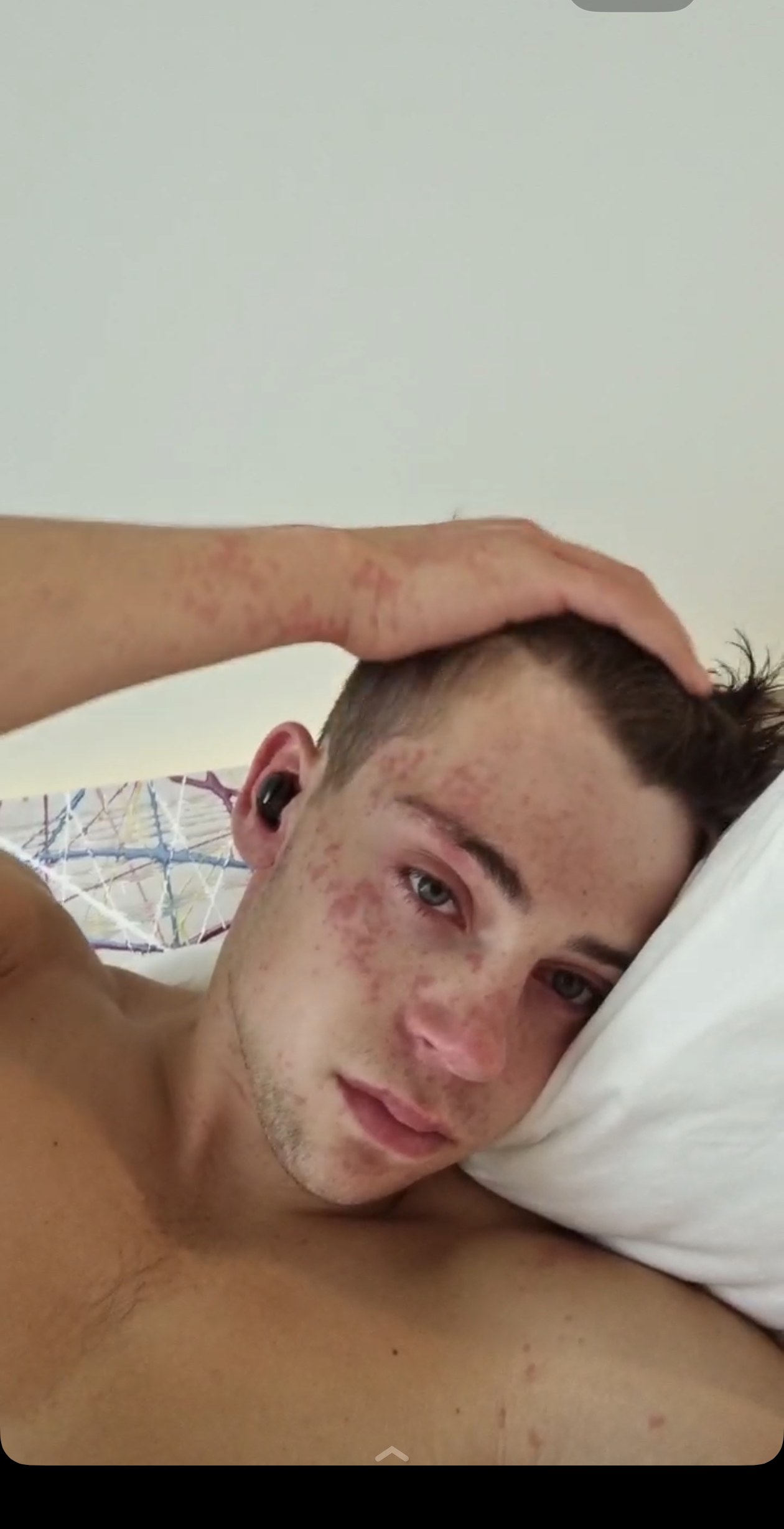 Marshall resting in bed during a flare