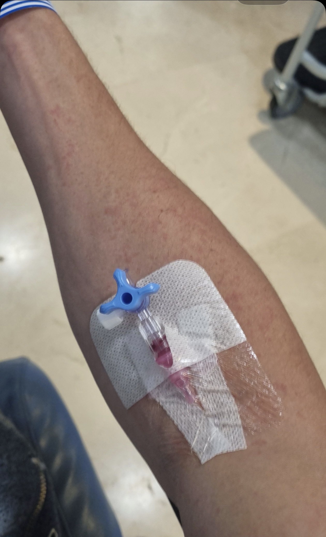 Marshall's arm with an IV cannula at hospital